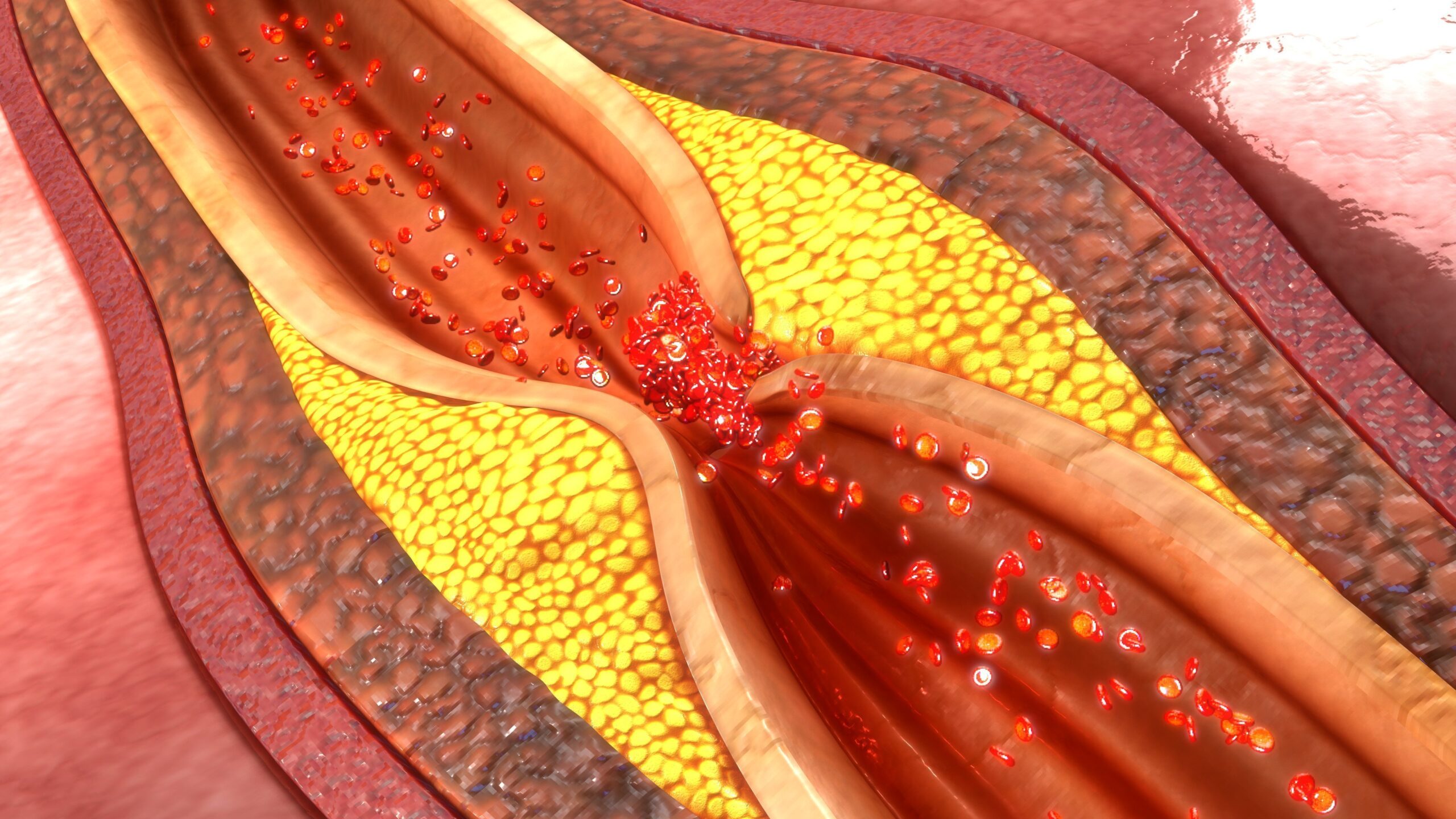 Coronary Artery Disease Cardiac Care Pima Heart Vascular